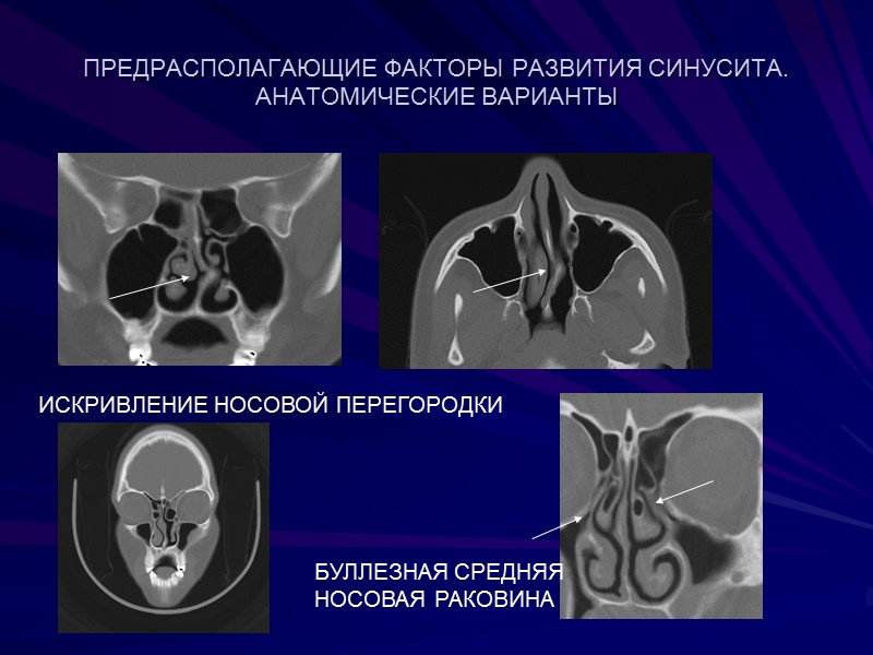 ПРЕДРАСПОЛАГАЮЩИЕ ФАКТОРЫ РАЗВИТИЯ СИНУСИТА. АНАТОМИЧЕСКИЕ ВАРИАНТЫ ИСКРИВЛЕНИЕ НОСОВОЙ ПЕРЕГОРОДКИ  БУЛЛЕЗНАЯ СРЕДНЯЯ НОСОВАЯ РАКОВИНА